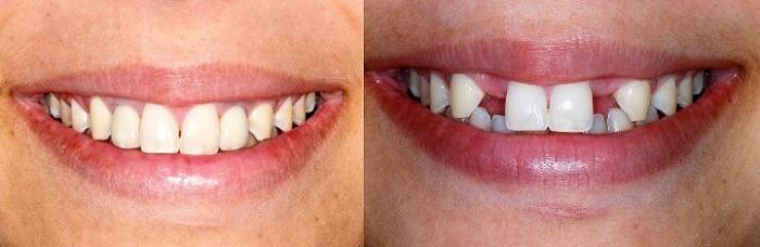 تأثير زراعة الأسنان على جمال الابتسامة