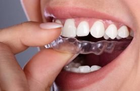 ما هو الحارس الليلي للأسنان وما فوائده؟ + أنواع