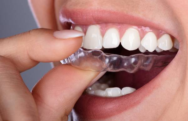 ما هو الحارس الليلي للأسنان وما فوائده؟ + أنواع