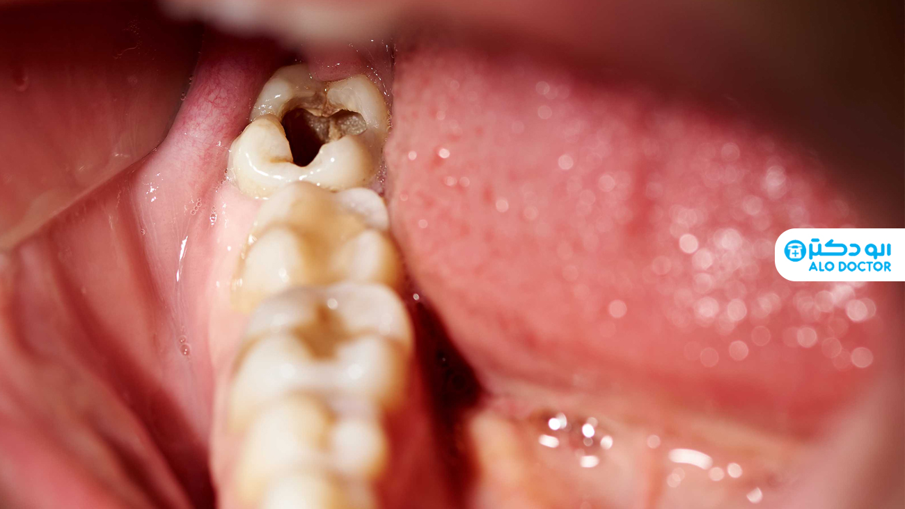 1626081753 3 متى يحدث تسوس الاسنان؟ ما هي اعراض واسباب حدوثه؟ أكو وب